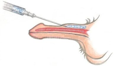 injekciós pénisz bővítés